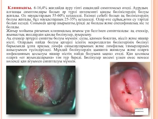 Клиникасы. 6-16,4% жағдайда ауру тіпті ешқандай симптомсыз өтеді. Аурудың алғашқы симптомдары болып әр