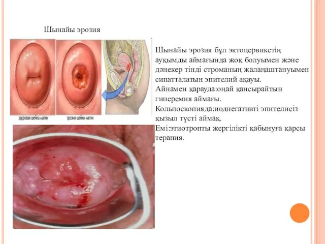 Шынайы эрозия Шынайы эрозия бұл эктоцервикстің ауқымды аймағында жоқ болуымен және дәнекер тінді