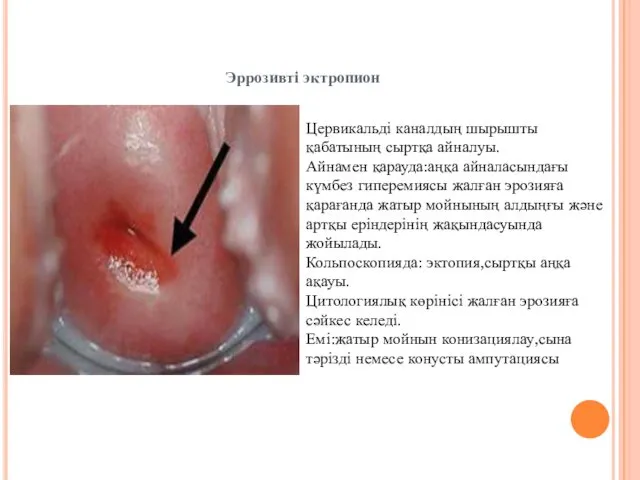 Цервикальді каналдың шырышты қабатының сыртқа айналуы. Айнамен қарауда:аңқа айналасындағы күмбез гиперемиясы жалған эрозияға