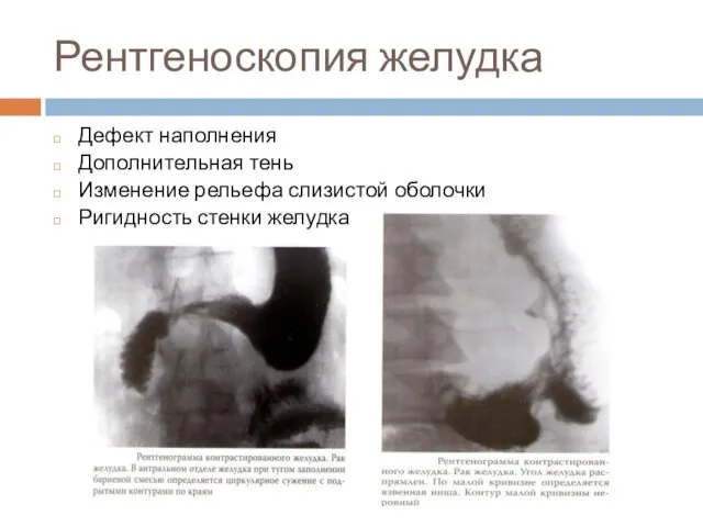 Рентгеноскопия желудка Дефект наполнения Дополнительная тень Изменение рельефа слизистой оболочки Ригидность стенки желудка