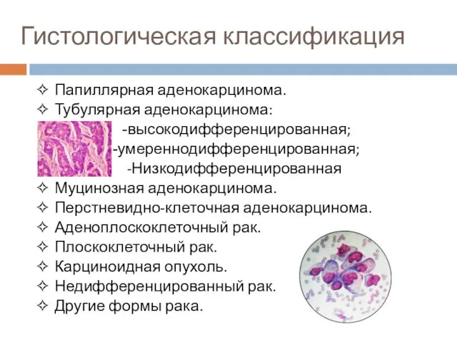 Гистологическая классификация ✧ Папиллярная аденокарцинома. ✧ Тубулярная аденокарцинома: -высокодифференцированная; -умереннодифференцированная;