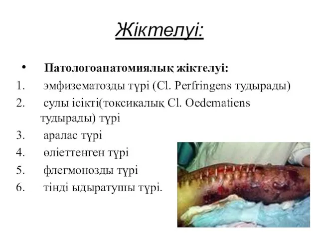 Жіктелуі: Патологоанатомиялық жіктелуі: эмфизематозды түрі (Cl. Perfringens тудырады) сулы ісікті(токсикалық Cl. Oedematiens тудырады)