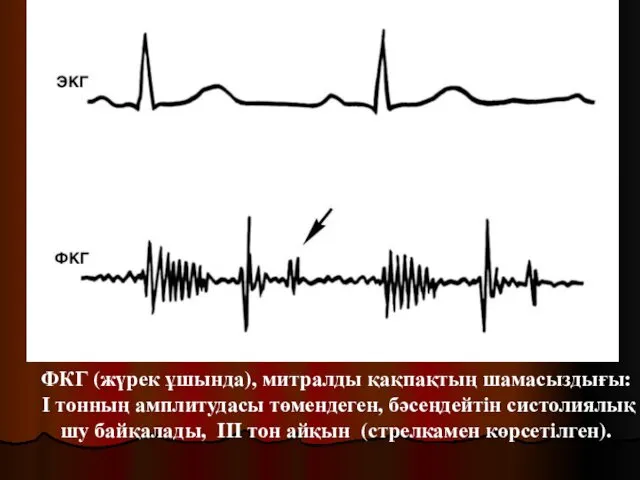 ФКГ (жүрек ұшында), митралды қақпақтың шамасыздығы: І тонның амплитудасы төмендеген,