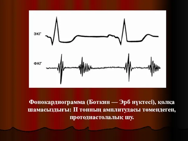 Фонокардиограмма (Боткин — Эрб нүктесі), қолқа шамасыздығы: ІІ тонның амплитудасы төмендеген, протодиастолалық шу.