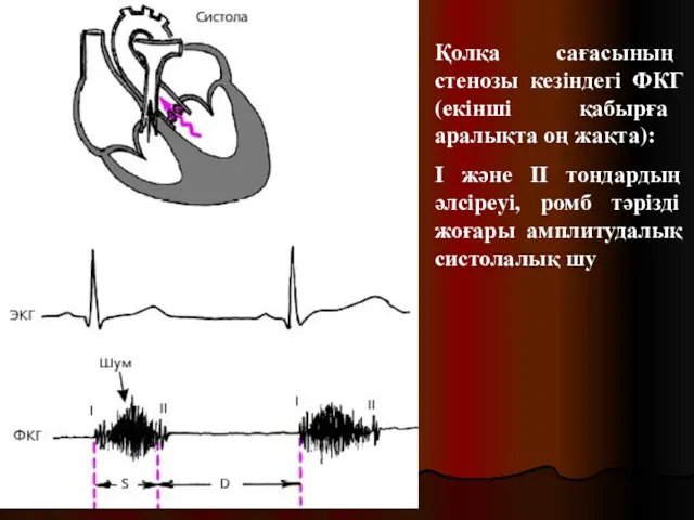 Қолқа сағасының стенозы кезіндегі ФКГ (екінші қабырға аралықта оң жақта):