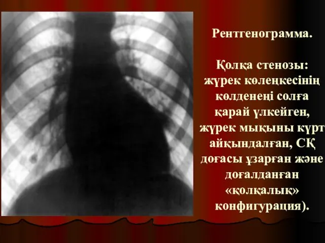 Рентгенограмма. Қолқа стенозы: жүрек көлеңкесінің көлденеңі солға қарай үлкейген, жүрек