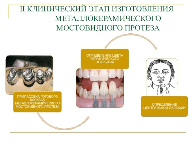 II КЛИНИЧЕСКИЙ ЭТАП ИЗГОТОВЛЕНИЯ МЕТАЛЛОКЕРАМИЧЕСКОГО МОСТОВИДНОГО ПРОТЕЗА