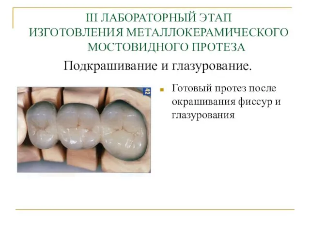 Подкрашивание и глазурование. Готовый протез после окрашивания фиссур и глазурования