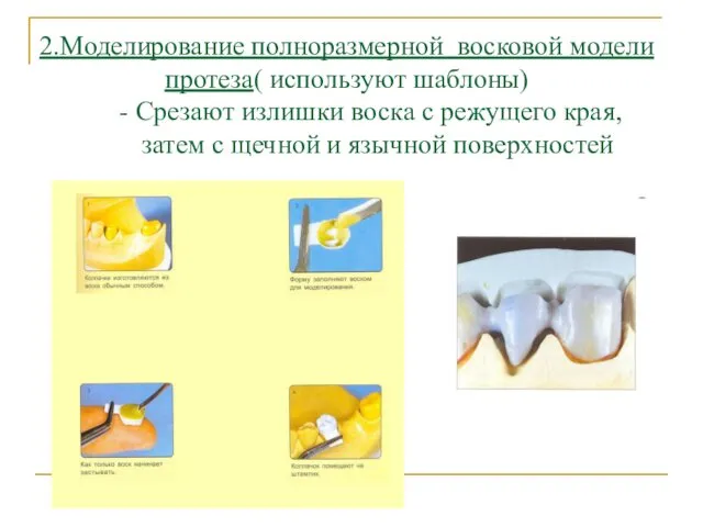 2.Моделирование полноразмерной восковой модели протеза( используют шаблоны) - Срезают излишки