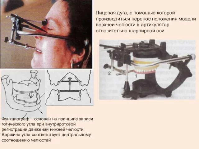 Функциограф – основан на принципе записи готического угла при внутриротовой