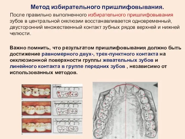 Метод избирательного пришлифовывания. После правильно выполненного избирательного пришлифовывания зубов в