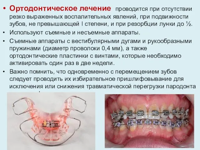 Ортодонтическое лечение проводится при отсутствии резко выраженных воспалительных явлений, при