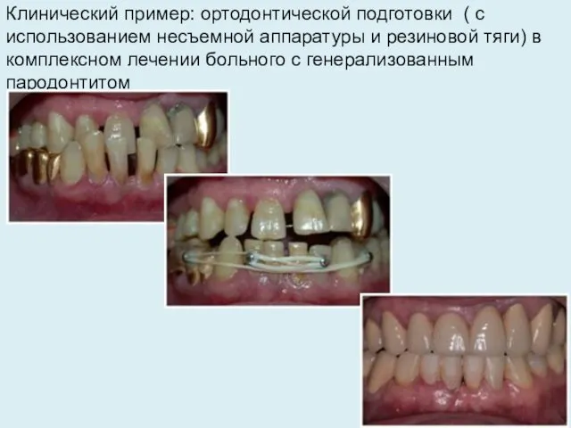 Клинический пример: ортодонтической подготовки ( с использованием несъемной аппаратуры и