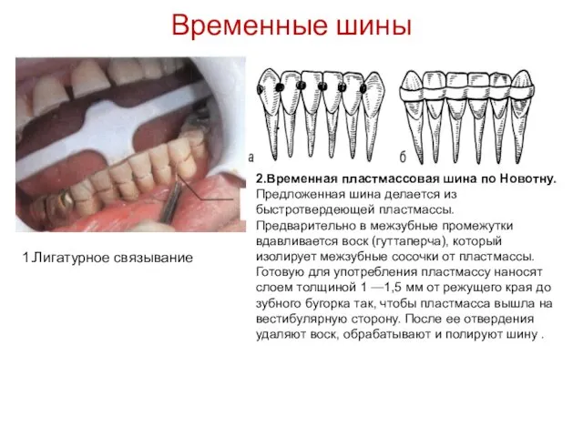 Временные шины 1.Лигатурное связывание 2.Временная пластмассовая шина по Новотну. Предложенная