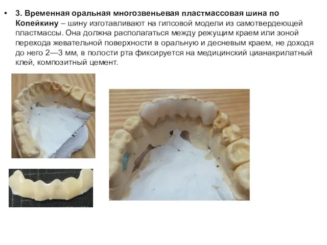 3. Временная оральная многозвеньевая пластмассовая шина по Копейкину – шину