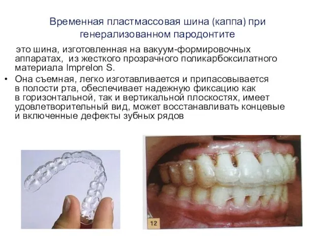 Временная пластмассовая шина (каппа) при генерализованном пародонтите это шина, изготовленная