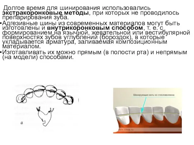 Долгое время для шинирования использовались экстракоронковые методы, при которых не