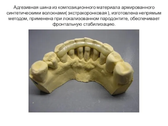 Адгезивная шина из композиционного материала армированного синтетическими волокнами( экстракоронковая ),