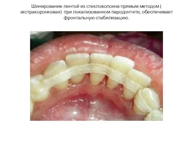 Шинирование лентой из стекловолокна прямым методом ( экстракоронковая) при локализованном пародонтите, обеспечивает фронтальную стабилизацию.