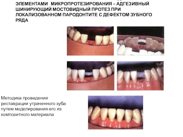 ШИНИРОВАНИЕ ЗУБОВ МОЖЕТ СОПРОВОЖДАТЬСЯ ЭЛЕМЕНТАМИ МИКРОПРОТЕЗИРОВАНИЯ – АДГЕЗИВНЫЙ ШИНИРУЮЩИЙ МОСТОВИДНЫЙ