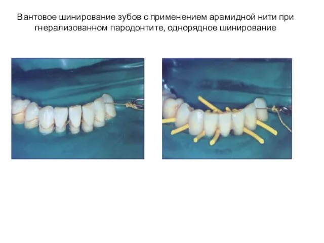 Вантовое шинирование зубов с применением арамидной нити при гнерализованном пародонтите, однорядное шинирование