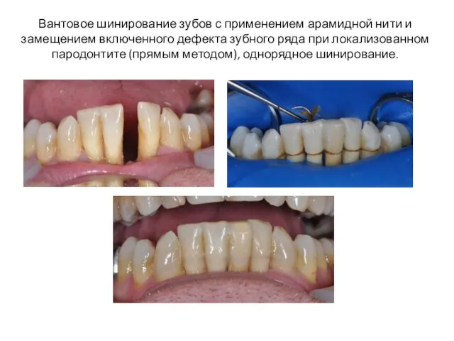 Вантовое шинирование зубов с применением арамидной нити и замещением включенного