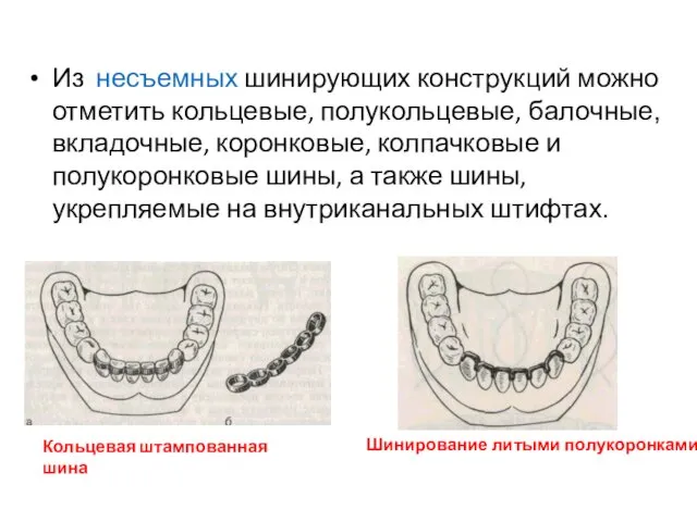 Из несъемных шинирующих конструкций можно отметить кольцевые, полукольцевые, балочные, вкладочные,