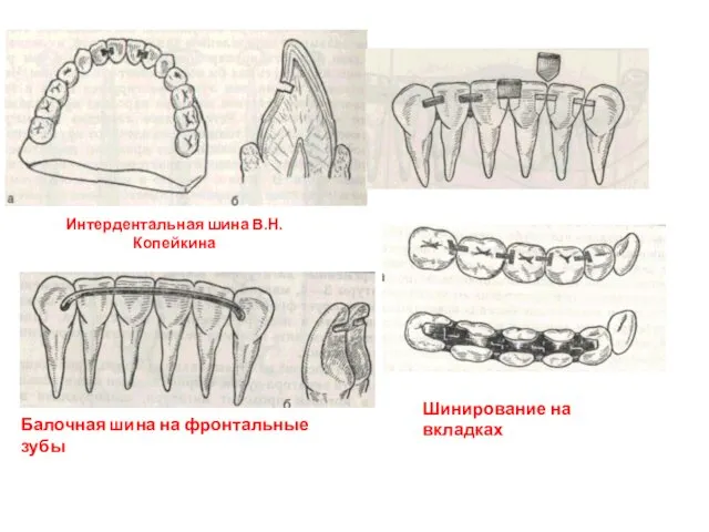 Интердентальная шина В.Н.Копейкина Шинирование на вкладках Балочная шина на фронтальные зубы