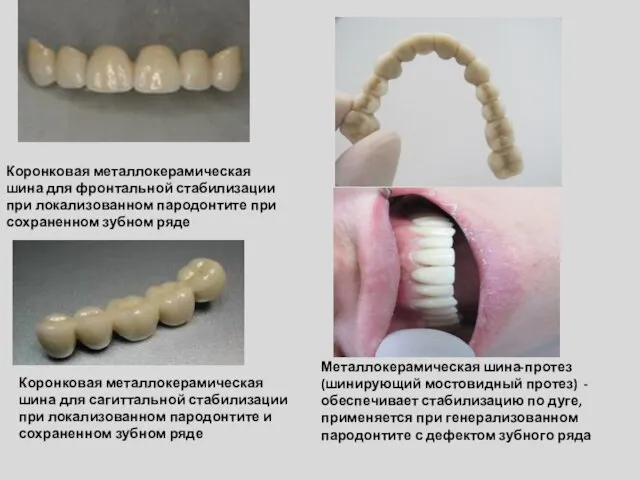 Коронковая металлокерамическая шина для фронтальной стабилизации при локализованном пародонтите при