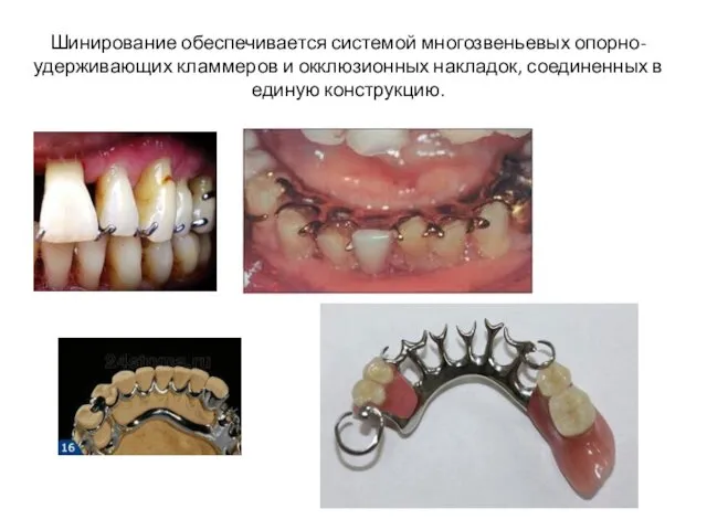 Шинирование обеспечивается системой многозвеньевых опорно-удерживающих кламмеров и окклюзионных накладок, соединенных в единую конструкцию.