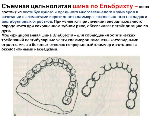 Съемная цельнолитая шина по Ельбрихту – шина состоит из вестибулярного