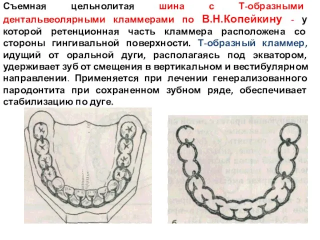 Съемная цельнолитая шина с Т-образными дентальвеолярными кламмерами по В.Н.Копейкину -