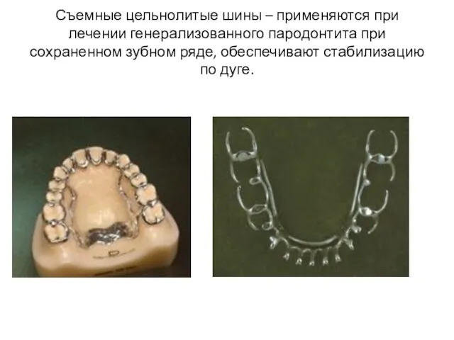 Съемные цельнолитые шины – применяются при лечении генерализованного пародонтита при