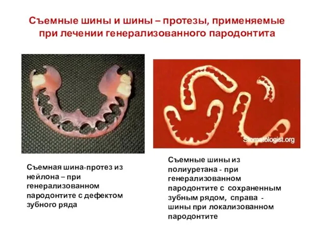 Съемные шины и шины – протезы, применяемые при лечении генерализованного