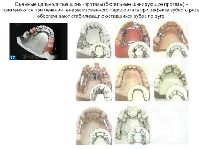 Съемные цельнолитые шины-протезы (бюгельные шинирующие протезы) – применяются при лечении