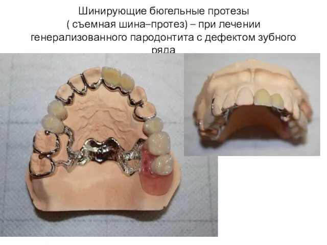 Шинирующие бюгельные протезы ( съемная шина–протез) – при лечении генерализованного пародонтита с дефектом зубного ряда