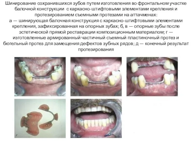 Шинирование сохранившихся зубов путем изготовления во фронтальном участке балочной конструкции