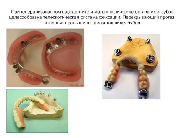При генерализованном пародонтите и малом количестве оставшихся зубов целесообразна телескопическая
