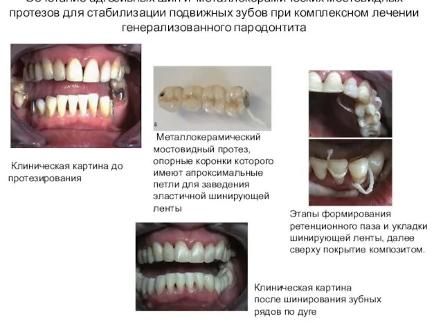 Сочетание адгезивных шин и металлокерамических мостовидных протезов для стабилизации подвижных