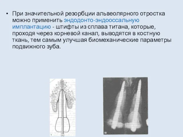 При значительной резорбции альвеолярного отростка можно применить эндодонто-эндооссальную имплантацию -