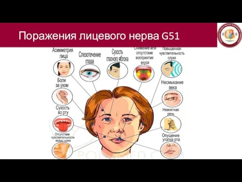 Поражения лицевого нерва G51