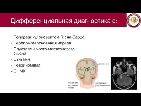Дифференциальная диагностика с: Полирадикулоневритом Гиена-Барре Переломом основания черепа Опухолями мосто-мозжечкового ствола Отитами Невриномами ОНМК