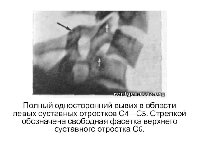 Полный односторонний вывих в области левых суставных отростков С4—С5. Стрелкой