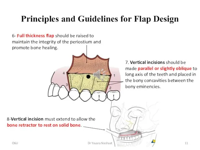 Principles and Guidelines for Flap Design 6- Full thickness flap