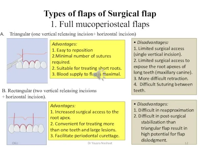 Types of flaps of Surgical flap 1. Full mucoperiosteal flaps