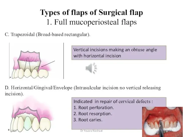 Types of flaps of Surgical flap 1. Full mucoperiosteal flaps