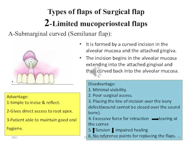 Types of flaps of Surgical flap 2-Limited mucoperiosteal flaps It