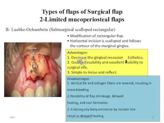 Types of flaps of Surgical flap 2-Limited mucoperiosteal flaps •