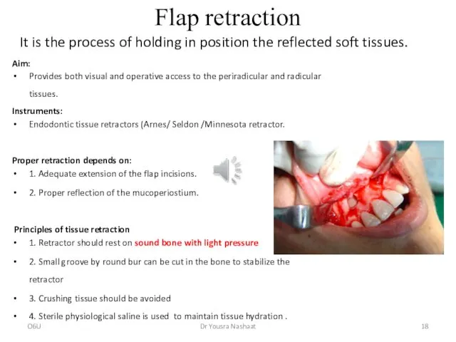 Flap retraction Aim: Provides both visual and operative access to