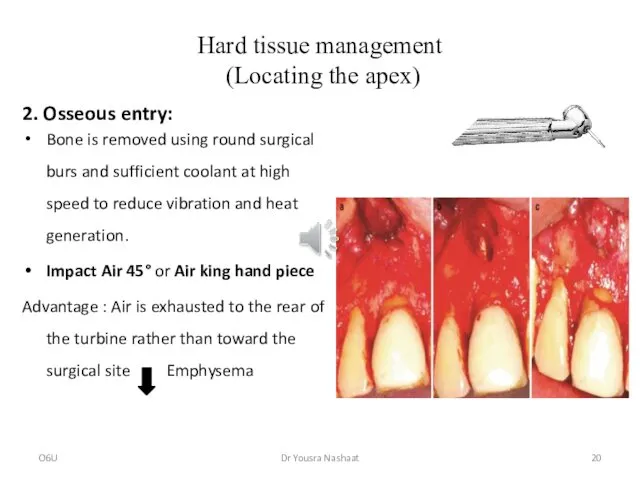 Hard tissue management (Locating the apex) 2. Osseous entry: Bone